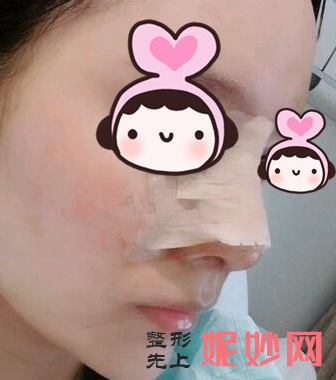 上海港华医院吕金陵医生技术怎么样?附隆鼻案例分析以及价格表。