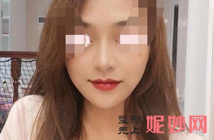 北京美莱医疗美容怎么样,医院介绍,附隆鼻修复案例分享和价格表!