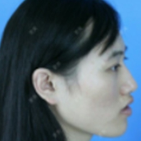 “整形上瘾”怎么办, 青岛诺德真人粉丝现场说法!