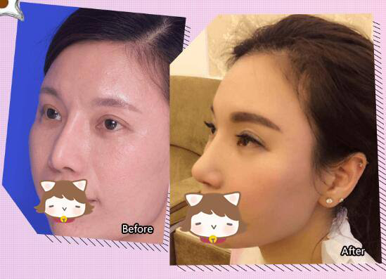 在武汉韩辰整形医院做完隆鼻手术,直接从路人甲蜕变TOP女神