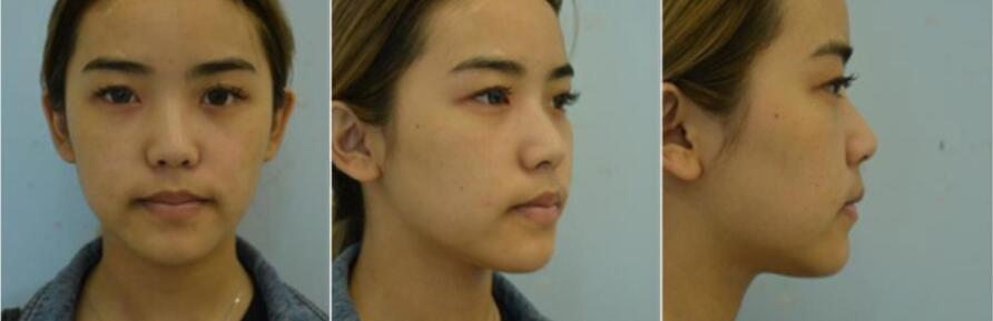 南宁梦想鼻整形医生整救颜面之王,让你无可“鼻”拟