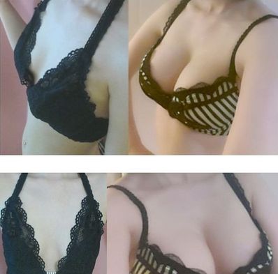 南宁贺尔美详解假体隆胸手术后,乳房严重变形、疼痛的原因