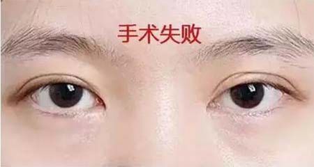 南宁伊晨详解双眼皮肿胀、不自然的原因