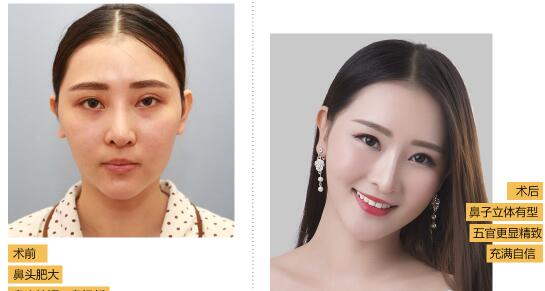 深圳希思是几级医院?正规的吗?整形怎么样?深圳希思医生案例效果图及价格表