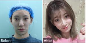 郑大二附院整形美容科是外包科室吗?郑大二附院整形医生简介_案例_价格表