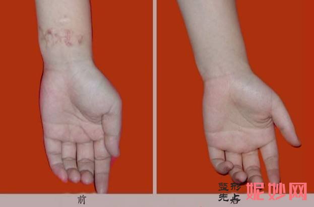 武汉华美是正规三甲医院吗?华美谭娜娜院长治疤痕怎么样?附案例效果_价格表