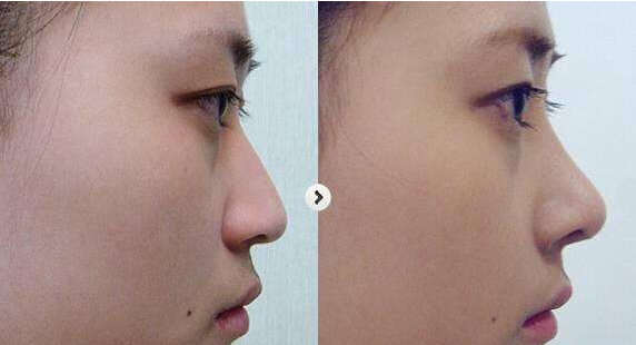 武汉美莱徐国建医生告诉你到底山根高好不好?