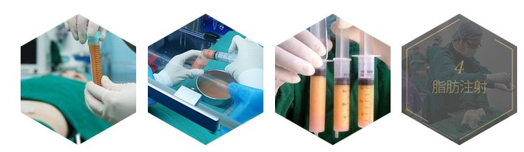 太原华美整形院长定制系列:无创口丰胸