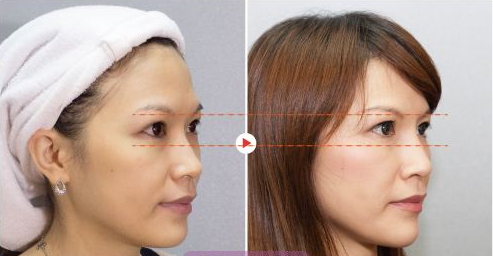 武汉美莱徐国建医生告诉你到底山根高好不好?