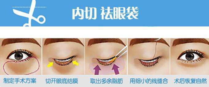 减龄神器:山大一院告诉不一样的内切去眼袋