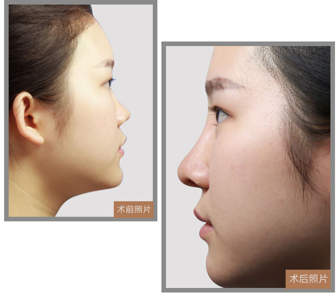 先天马鞍鼻,去南宁韩星整形做假体隆鼻怎么样?