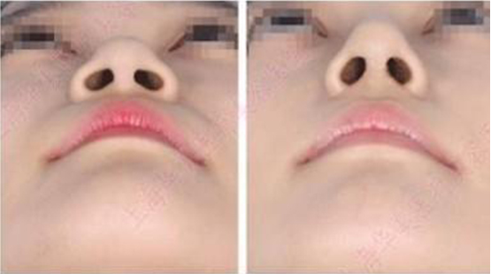 先天马鞍鼻,去南宁韩星整形做假体隆鼻怎么样?