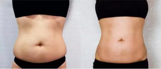 28岁女生想做吸脂,问下南宁华美整形医院开展水动力吸脂吗?