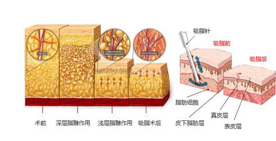 28岁女生想做吸脂,问下南宁华美整形医院开展水动力吸脂吗?