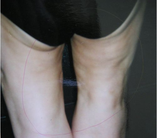 28岁女生想做吸脂,问下南宁华美整形医院开展水动力吸脂吗?