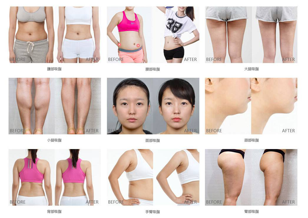 沈阳杏林整容医院:突破传统,重新定义吸脂技术