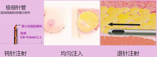 太原华美整形院长定制系列:无创口丰胸