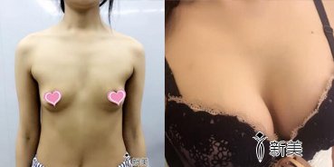 假体隆胸前后照片对比 水滴假体隆胸一个月