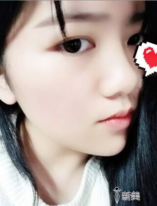 福州爱美尔黄振银面部吸脂亲身经历有图