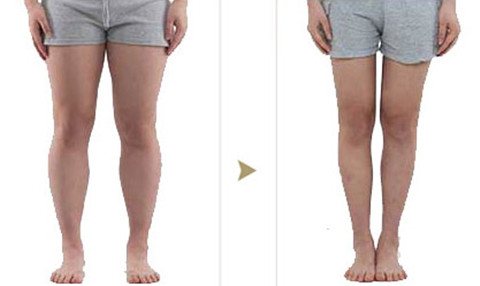 吸脂瘦大腿术前术后 吸脂瘦大腿术前术后