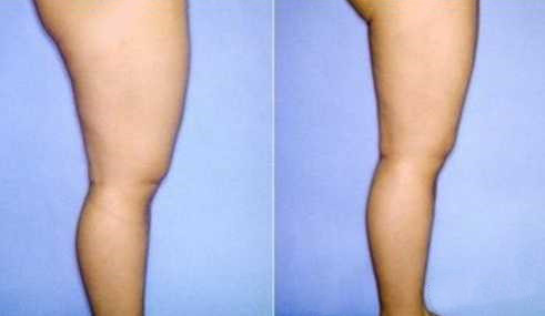 射频溶脂瘦臀部术前术后 射频溶脂瘦臀部术前术后