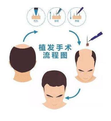 头顶加密种植 头顶加密种植