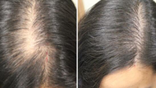 头顶加密种植 头顶加密种植