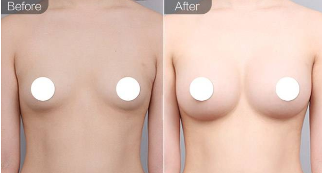 自体脂肪隆胸 自体脂肪隆胸