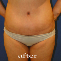 整形前后对比图片