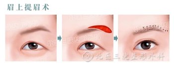 上眼皮松弛矫正 眉上提眉术