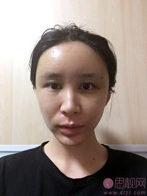 常双明脂肪填充怎么样?附案例及2021年全新价格表公开