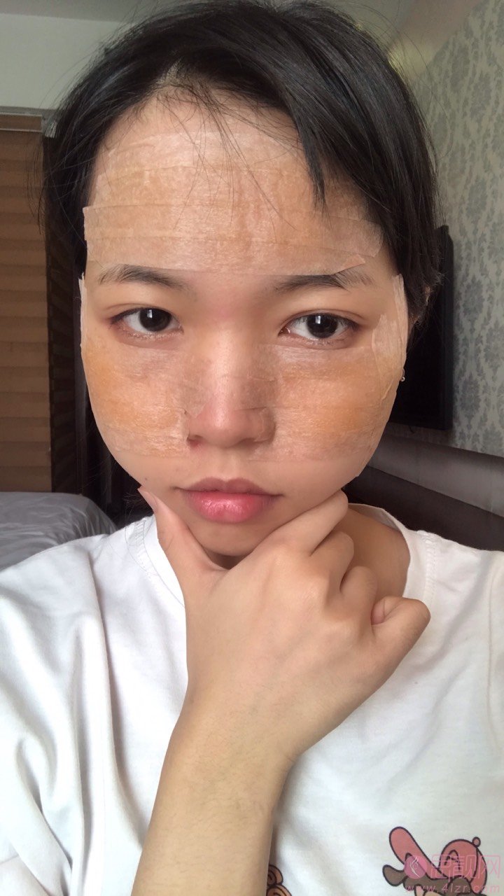 重庆医佑美曾志权医疗美容曾志权颧骨内推怎么样?附案例及2021年价格表曝光