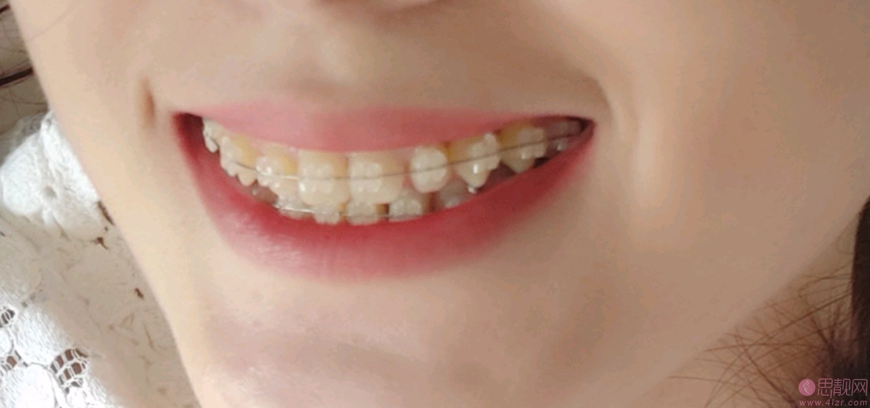 北京圣贝口腔医院矫正牙齿贵吗?2021年价格表全新发布+术后真人案例分享