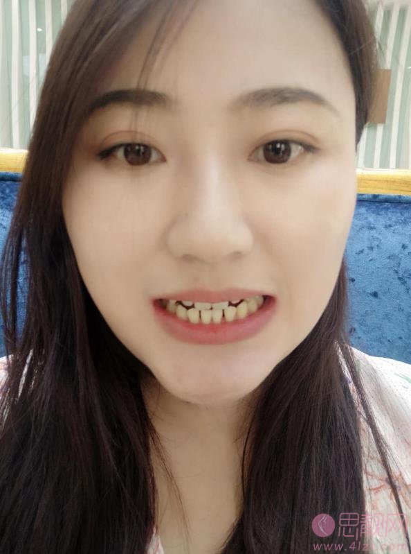 北京圣贝口腔医院矫正牙齿贵吗?2021年价格表全新发布+术后真人案例分享