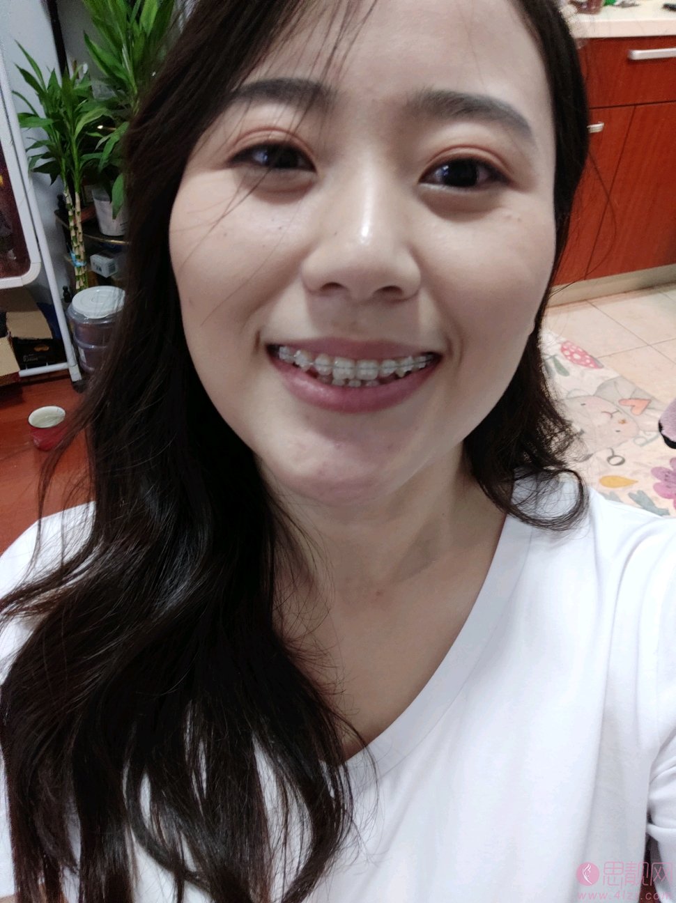 北京圣贝口腔医院矫正牙齿贵吗?2021年价格表全新发布+术后真人案例分享