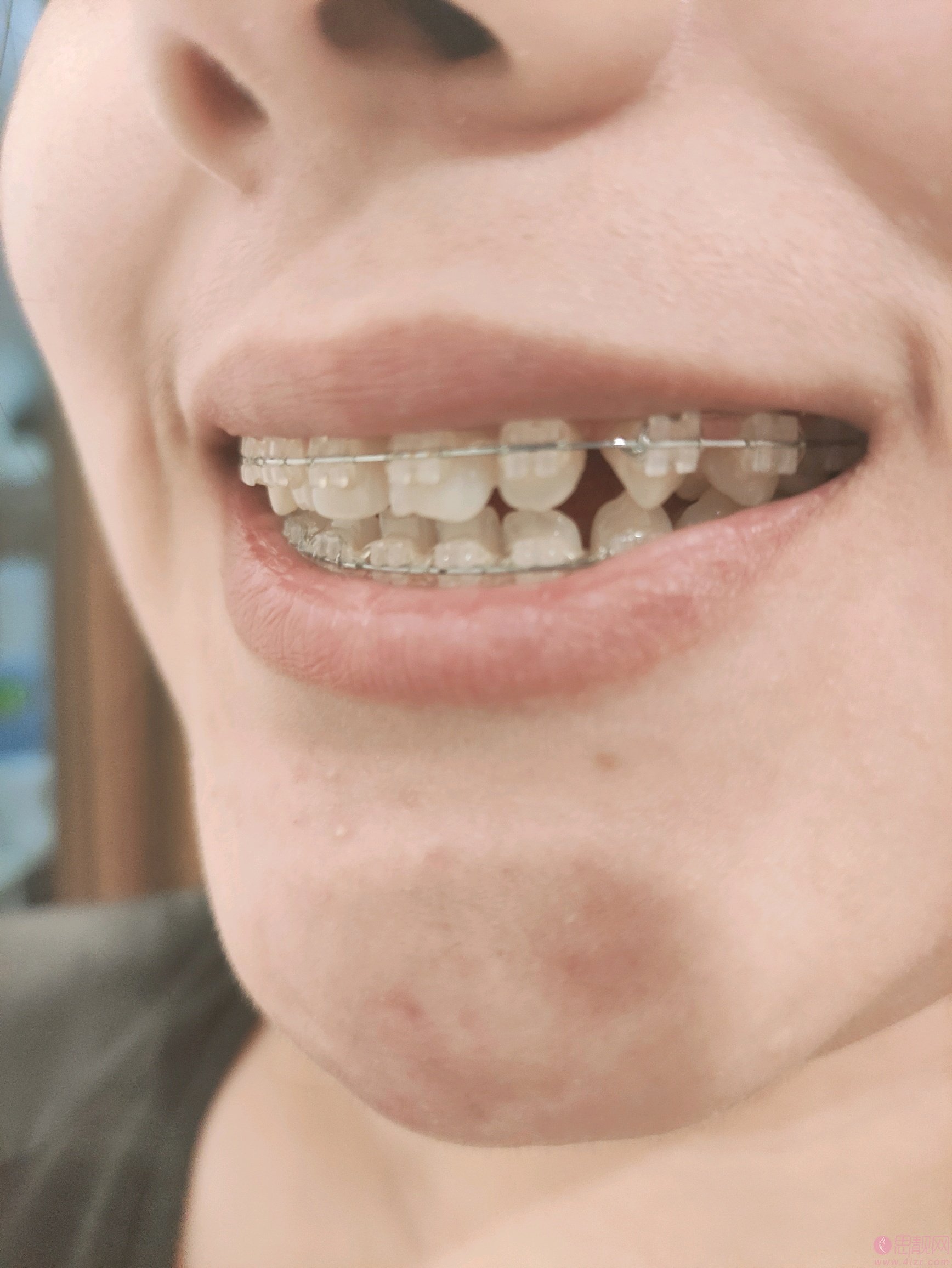 北京圣贝口腔医院矫正牙齿贵吗?2021年价格表全新发布+术后真人案例分享