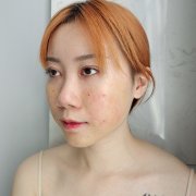 激光祛痘坑怎么样？术后真人案例效果反馈