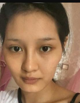 北京自体脂肪填充医院排名,附脂肪填充医生及案例 北京自体脂肪填充医院排名,附脂肪填充医生及案例