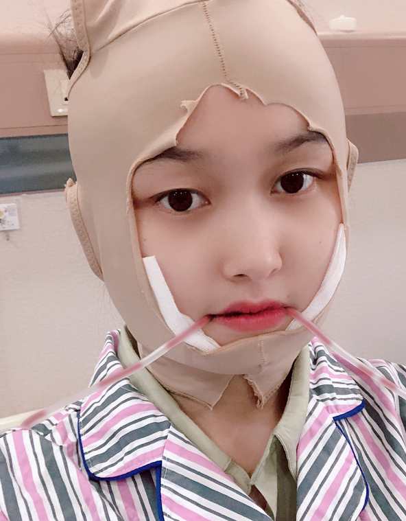 张立天做下颌角怎么样?附术后真人案例分享+2021价格表曝光 张立天做下颌角怎么样?附术后真人案例分享+2021价格表曝光