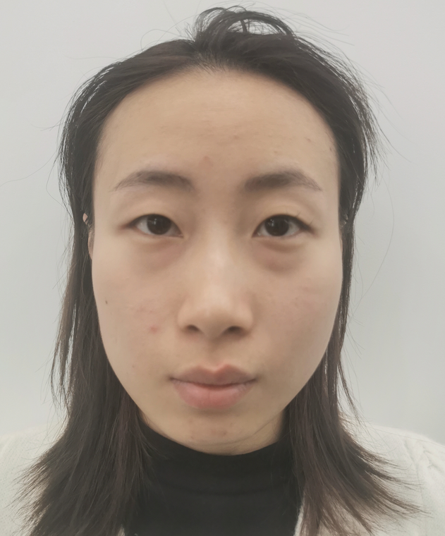 杭州健丽余慧云医生祛眼袋怎么样?术前后效果对比+2021价格表 杭州健丽余慧云医生祛眼袋怎么样?术前后效果对比+2021价格表