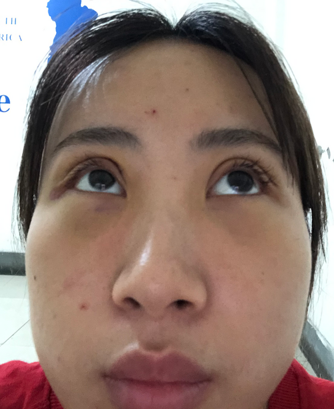 杭州健丽余慧云医生祛眼袋怎么样?术前后效果对比+2021价格表 杭州健丽余慧云医生祛眼袋怎么样?术前后效果对比+2021价格表