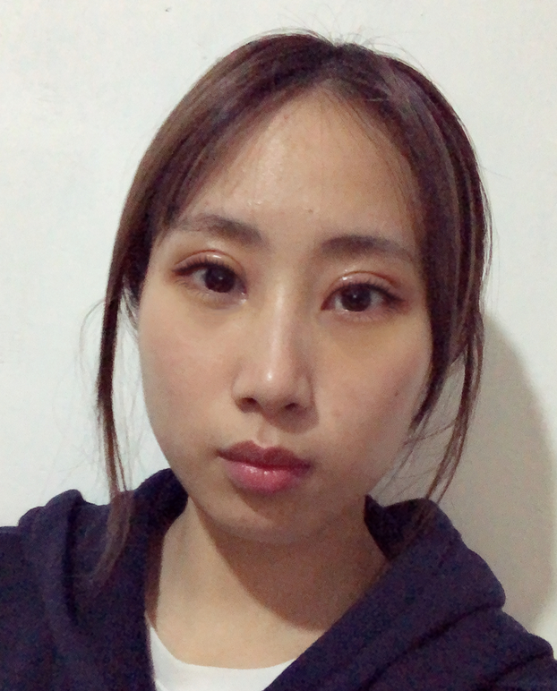 杭州健丽余慧云医生祛眼袋怎么样?术前后效果对比+2021价格表 杭州健丽余慧云医生祛眼袋怎么样?术前后效果对比+2021价格表