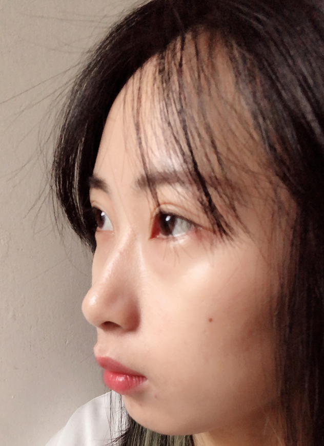 杭州健丽余慧云医生祛眼袋怎么样?术前后效果对比+2021价格表 杭州健丽余慧云医生祛眼袋怎么样?术前后效果对比+2021价格表