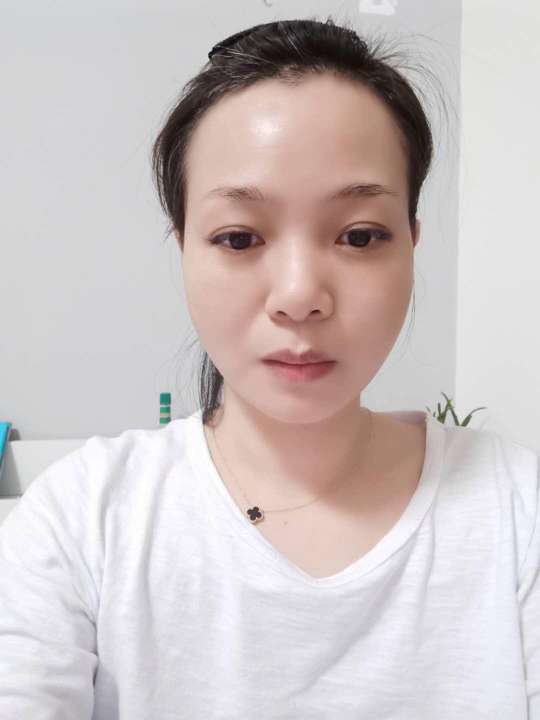 拉皮手术2021价格表一览+术后真人效果反馈