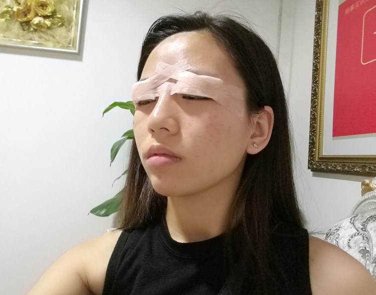 田国静修复双眼皮价格?2021价格表曝光+眼修复案例反馈 田国静修复双眼皮价格?2021价格表曝光+眼修复案例反馈