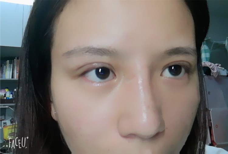 田国静修复双眼皮价格?2021价格表曝光+眼修复案例反馈 田国静修复双眼皮价格?2021价格表曝光+眼修复案例反馈