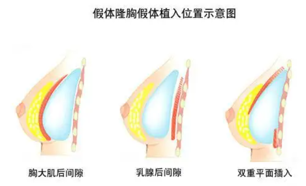 杨佳琦:隆胸会影响哺乳吗?