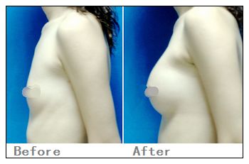 假体隆胸对比照