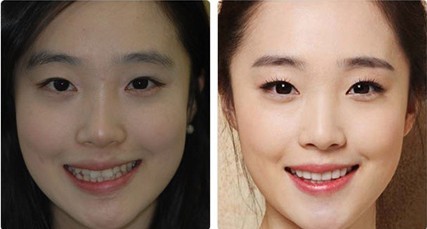 地包天矫正对比图