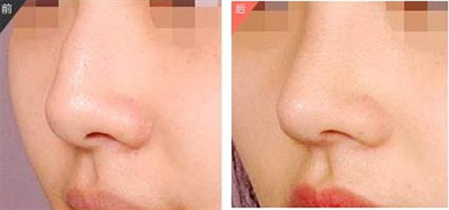 玻尿酸隆鼻对比案例 玻尿酸隆鼻对比案例
